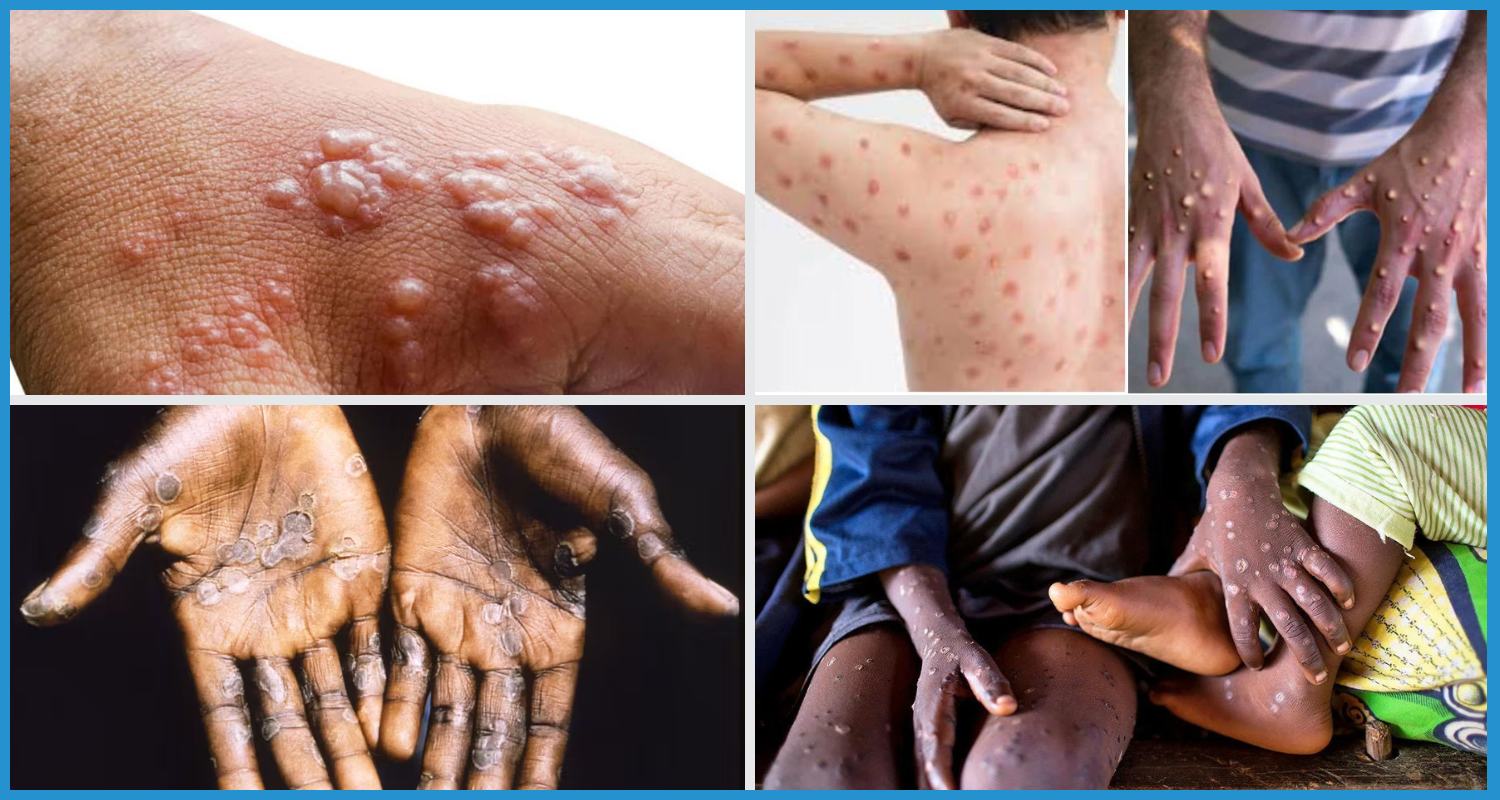 showing the image of MPOX Virus (Monkeypox Virus)